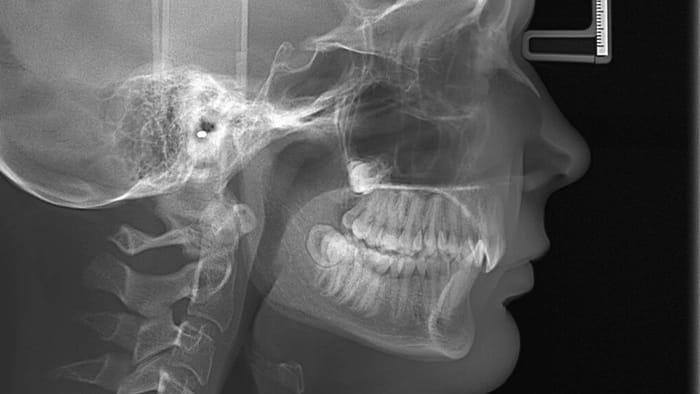 Cephalometric Rontgen