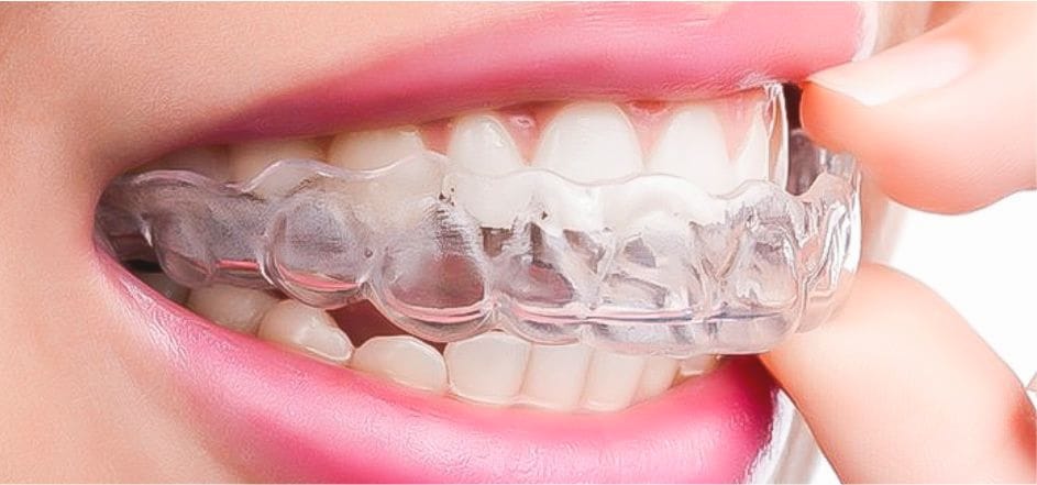 Clear Aligner