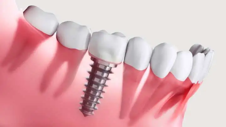 Dental Implant
