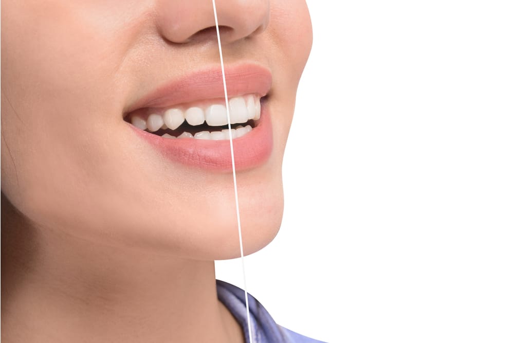 Gingivectomy