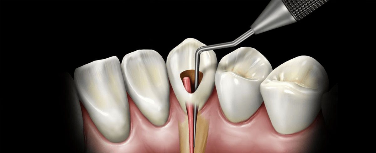 Nerve Treatment