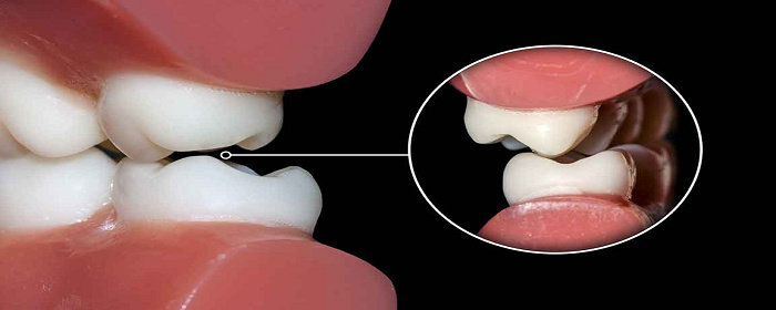 Occlusal Adjustment