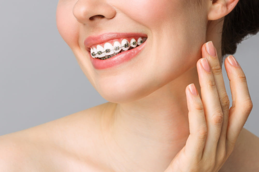 Clear Aligner