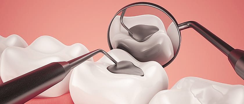 Rear Tooth Fillings