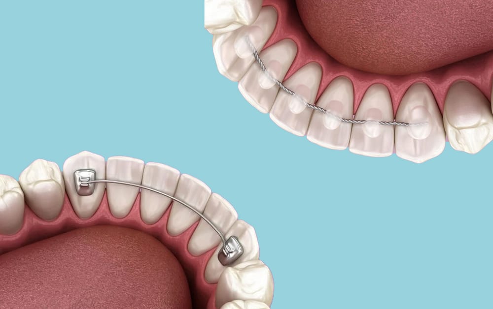 Retainer