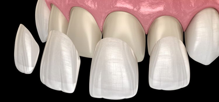 Veneer