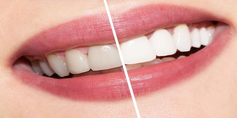 Whitening