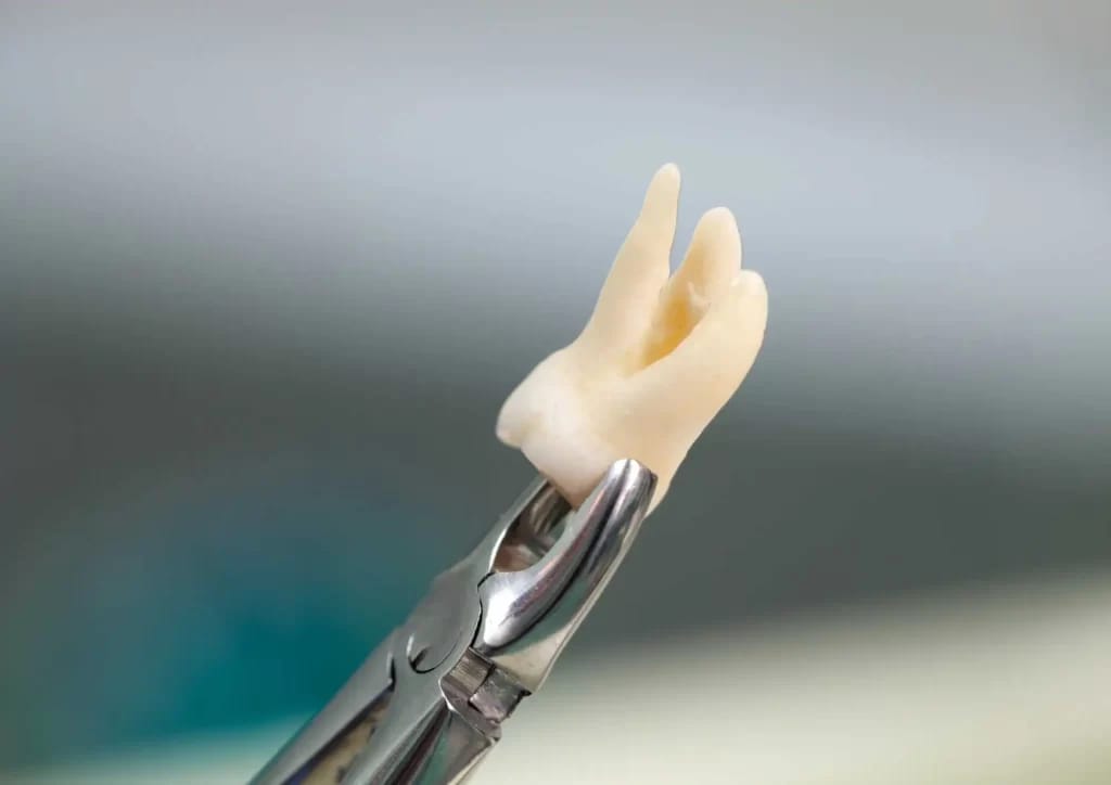 Wisdom Tooth Extraction